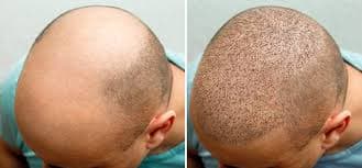 Hair Transplant Turkey: Before and After Results You’ll Love