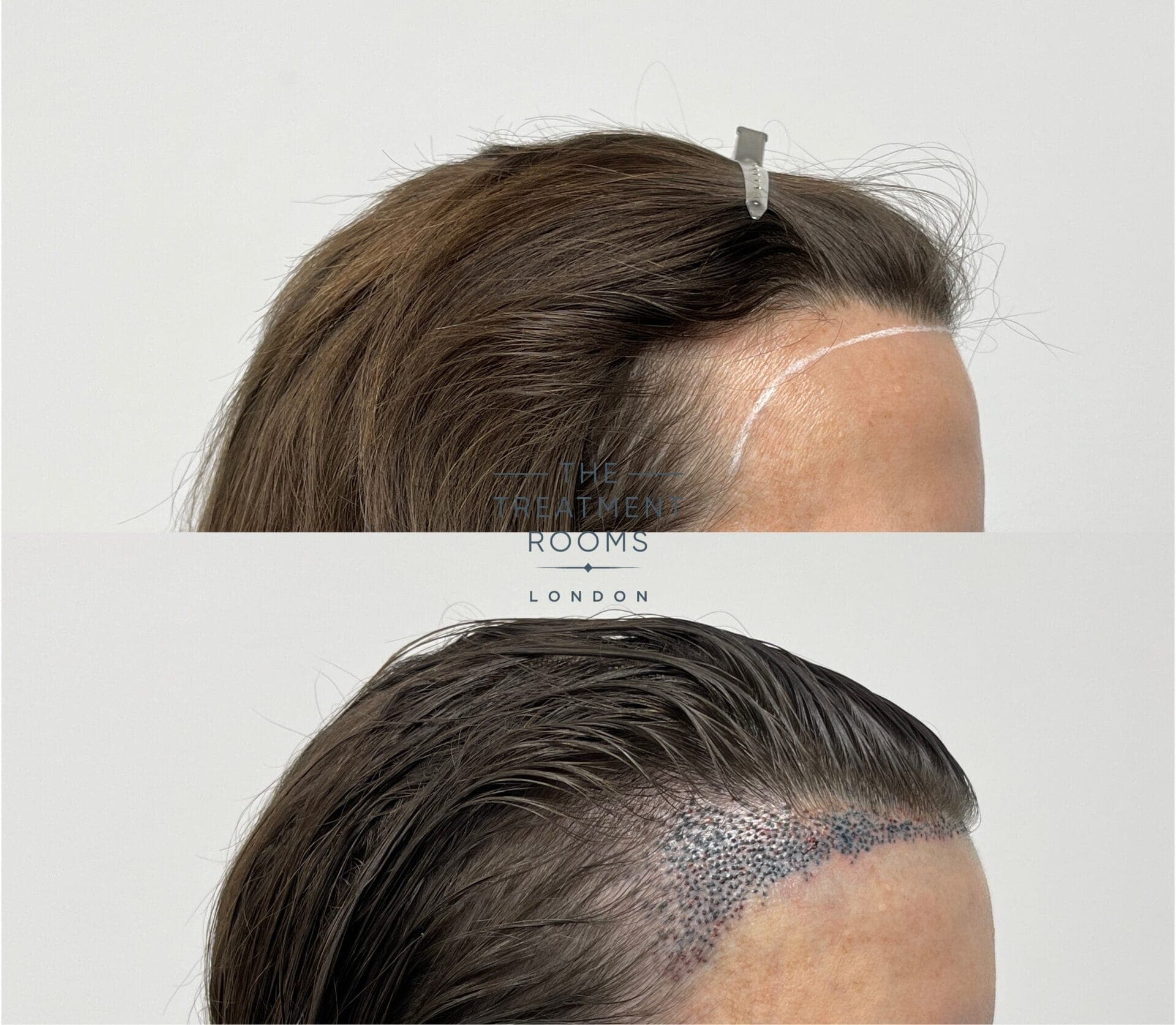 Hair Transplant – Why Choose Westminster Medical Group®