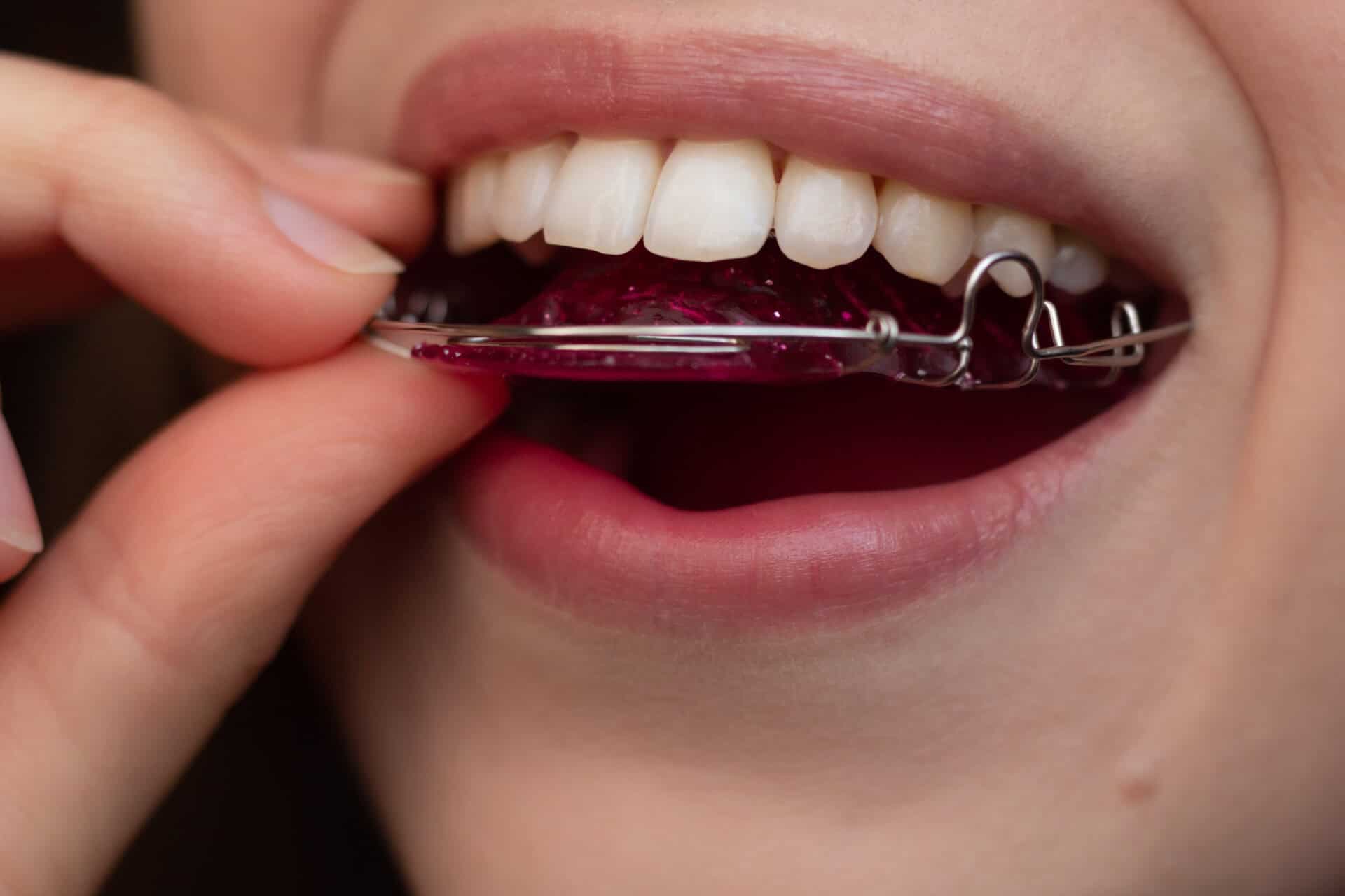 Ceramic Braces Care Tips for a Healthy and Beautiful Smile